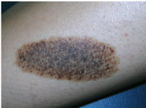 <p><span>A flat lesion &gt;1 cm in size without elevation or depression</span></p>