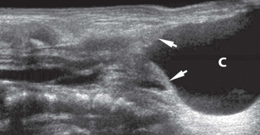 <p>CSD</p><p>fluid filled lumbar mass</p><p>CSF accumulation </p><p>omphalocele </p>