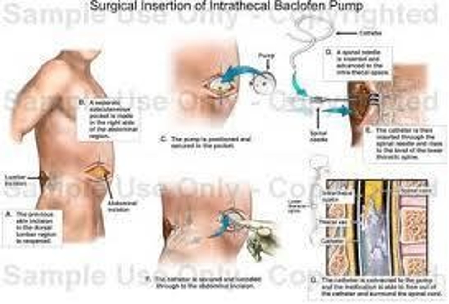 <p>To deliver baclofen directly to the subarachnoid space surrounding a specific level of the spinal cord.</p>