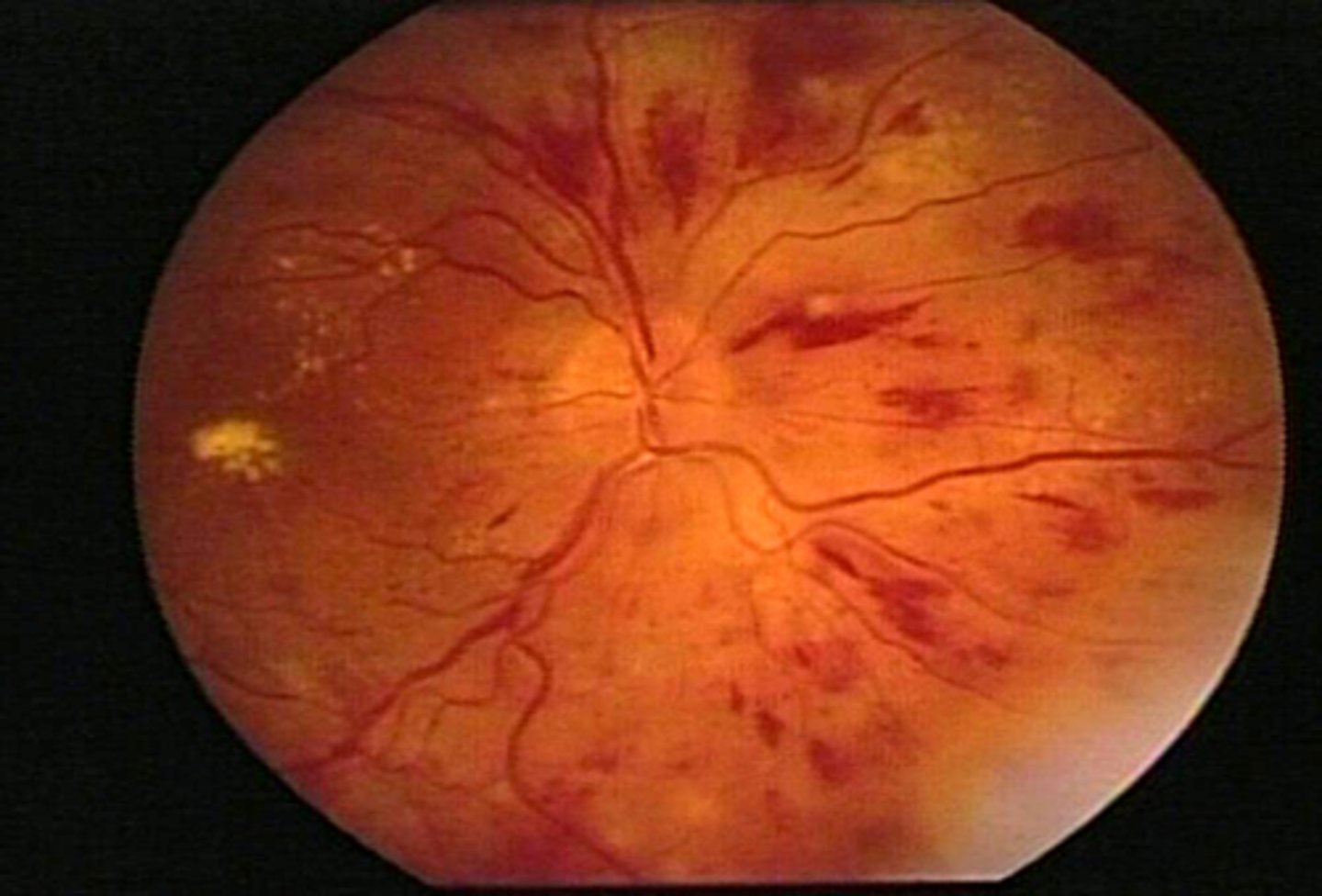 <p>-Second only to diabetic retinopathy in prevalence</p><p>-Clinical presentation depends upon severity, duration, and degree of control</p>