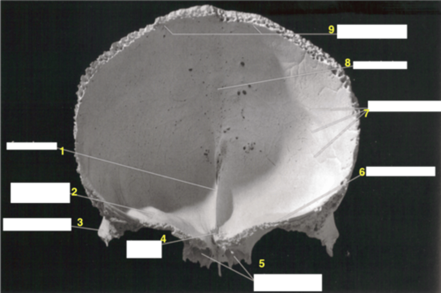 <p>indentations on frontal bone from arachnoid mater layer of skull/brain's soft tissue</p>