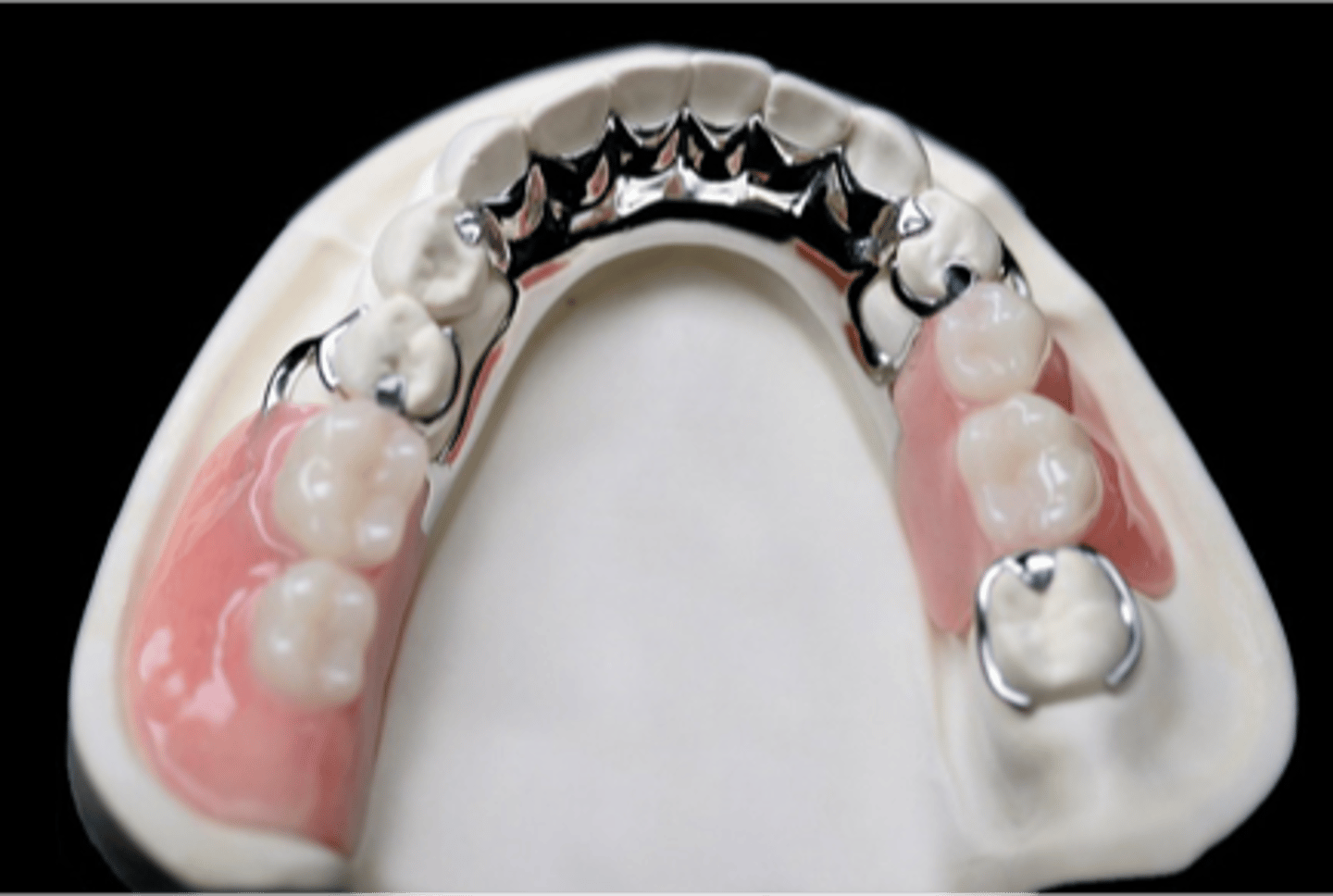 <p>A prosthesis that replaces one or more missing teeth and contiguous tissues Is designed to be removed by the wearer Is supported and retained by teeth, implants, soft tissue or a combination</p>