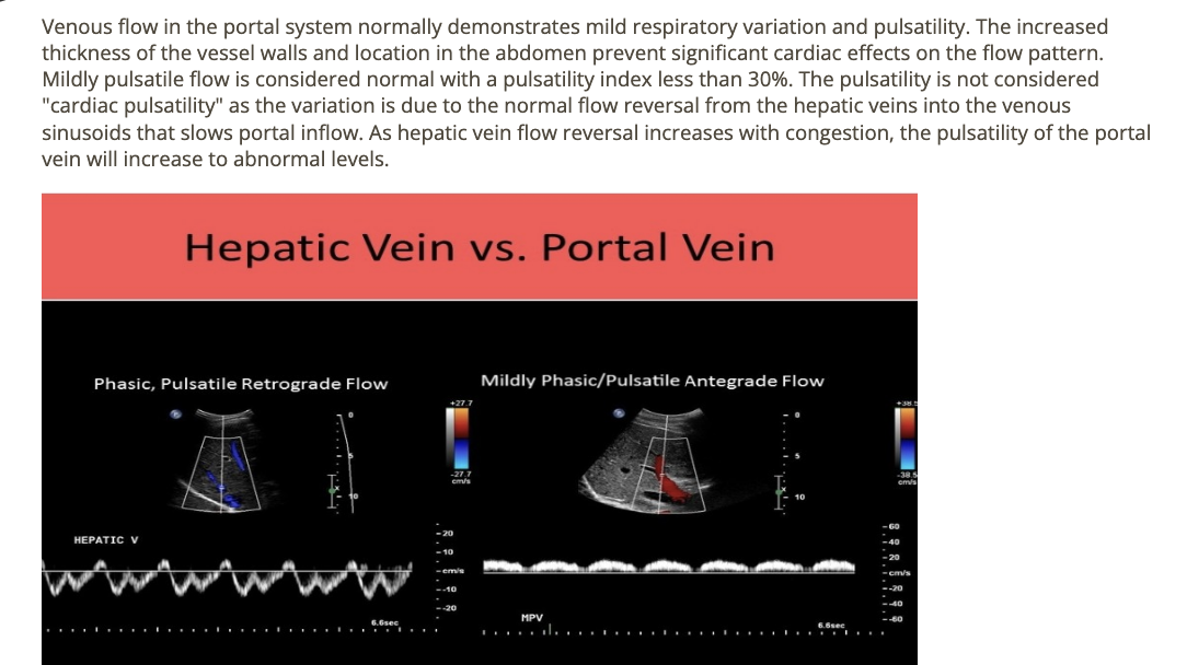 <p>a. mild pulsatility w/respiratory variation</p>