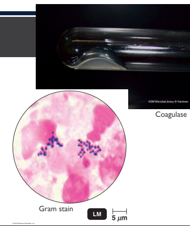 <p>(LC) A patient has a swollen, red area on his thigh. It is warm and tender to the touch. Based on the Gram stain and coagulase test results shown below, what is the likely cause of the infection?</p><ol><li><p><em>Streptococcus pyogenes</em></p></li><li><p><em>Pseudomonas aeruginosa</em></p></li><li><p><em>Staphylococcus aureus</em></p></li><li><p><em>Staphylococcus epidermidis</em></p></li></ol><p></p>
