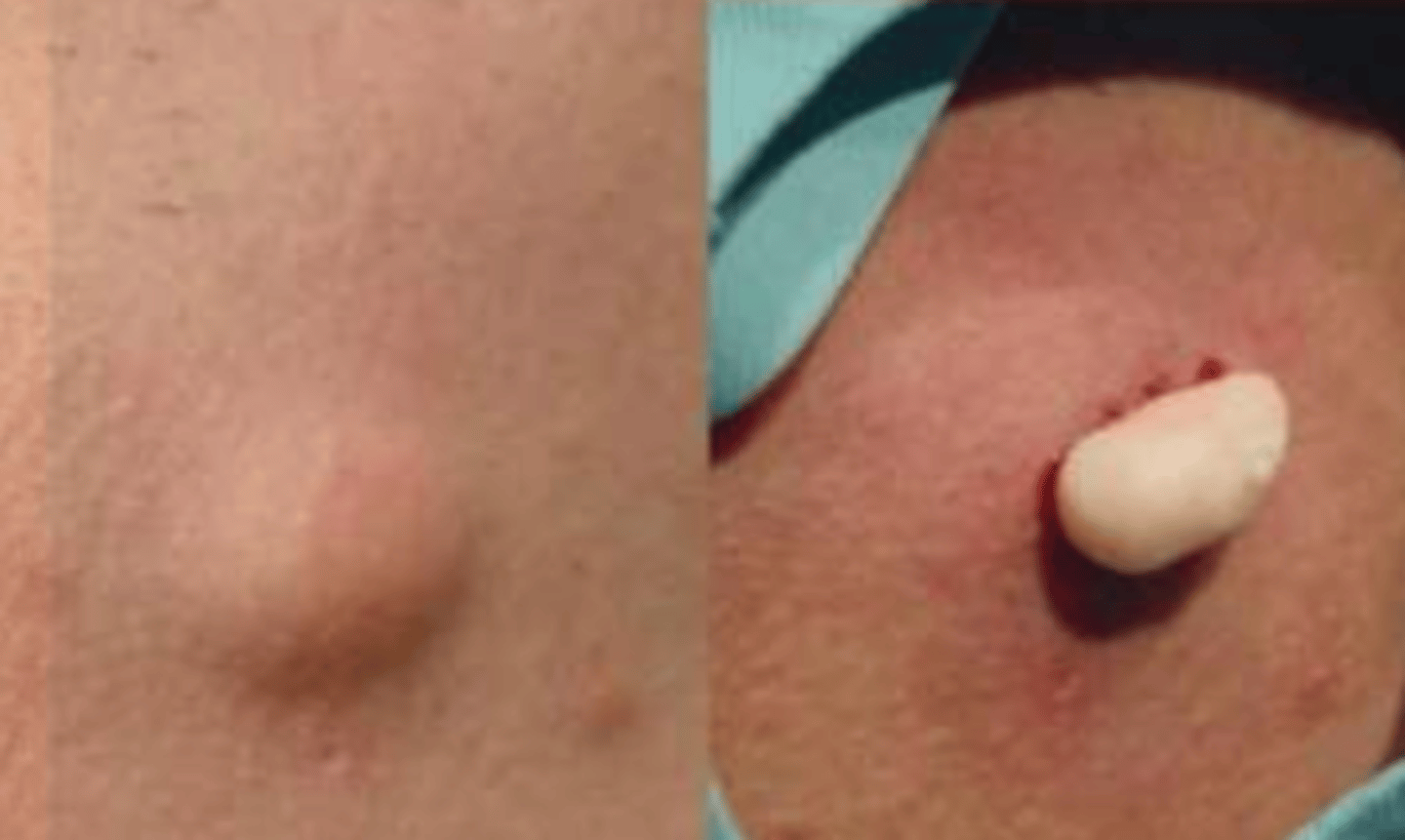 <p>¿lesión?</p><p>¿primaria o secundaria?</p>