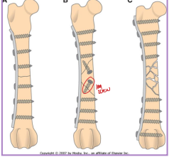 <ul><li><p><span style="background-color: transparent;"><strong><span>What:</span></strong></span></p><ul><li><p><span style="background-color: transparent;"><strong><span>Round </span></strong><span>(compression) or </span><strong><span>oval</span></strong><span> holes @ fracture line</span></span></p></li><li><p><span style="background-color: transparent;"><strong><span>Dynamic compression plate</span></strong><span> (DCP)</span></span></p></li><li><p><span style="background-color: transparent;"><strong><span>Limited-contact DCP</span></strong><span> (LC-DCP)</span></span></p></li><li><p><span style="background-color: transparent;"><strong><span>Locking plates: </span></strong></span><span style="background-color: transparent; color: red;"><span>rigid</span></span><span style="background-color: transparent;"><span> plate-screw interface, </span><u><span>for poor bone quality</span></u><span>, less contouring needed</span></span></p></li></ul></li><li><p><span style="background-color: transparent;"><strong><span>Why: </span></strong></span></p><ul><li><p><span style="background-color: transparent;"><strong><span>Compression</span></strong><span>: transverse fractures (plate/screws)</span></span></p></li><li><p><span style="background-color: transparent;"><strong><span>Neutralization</span></strong><span>: protects adjunct fixation (lag screw/cerclage + plate/screws)</span></span></p></li><li><p><span style="background-color: transparent;"><strong><span>Buttress</span></strong><span>: plate carries full load for unstable fracture</span></span></p></li></ul></li><li><p><span style="background-color: transparent;"><strong><span>How:</span></strong></span></p><ul><li><p><span style="background-color: transparent;"><span>Apply to </span><u><span>tension surface</span></u><span> of bone</span></span></p></li><li><p><span style="background-color: transparent;"><strong><span>Must engage</span></strong></span><span style="background-color: transparent; color: red;"><strong><span> </span><u><span>≥6 cortice</span></u></strong></span><span style="background-color: transparent;"><strong><u><span>s on each side of fracture!!</span></u></strong></span></p></li></ul></li></ul><p></p>