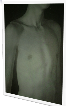 <p>Pectus carinatum</p>