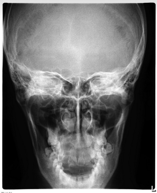 The anterior-posterior view where pt facing away from receptor and chin tilted down -30 degrees