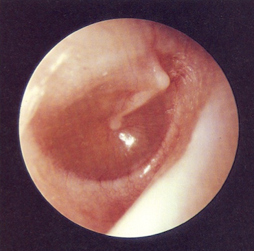 <p><u>disordered otoscopy: middle ear</u></p><p>otitis media</p>