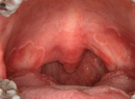 <p><span><span>harmless, non-contagious inflammatory condition causing smooth, red, map-like patches with white borders on the tongue's surface or buccal mucosa/palate</span></span> </p>