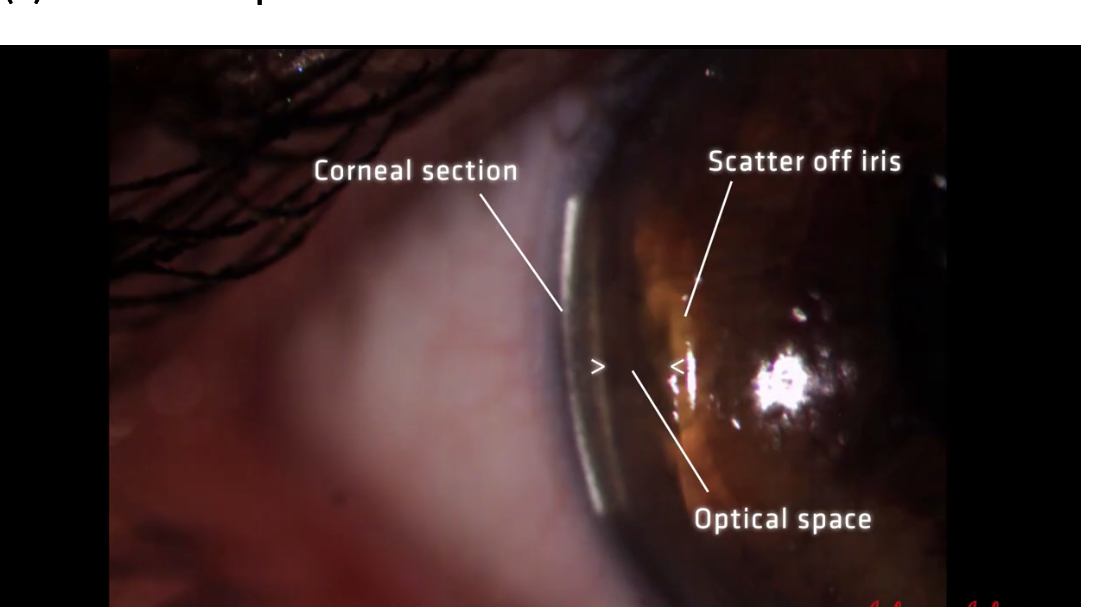 <p>Move optic section to temporal cornea </p><p>Keep observation system straight ahead </p><p>Then angle illumination system 60 degrees temporally </p><p>Increase mag 25x </p><p>Examine space between corneal section and iris scatter: this space represents the aqueous </p>