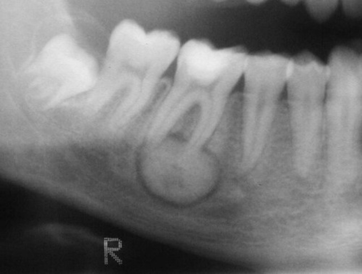 <p>has a radiolucent rim and has radiopaque inside</p>