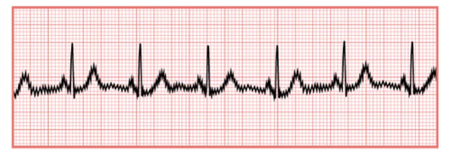 <p>AC interference - see SPIKES</p>