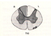 <p>a lesion here would result in what clinical presentation?</p>