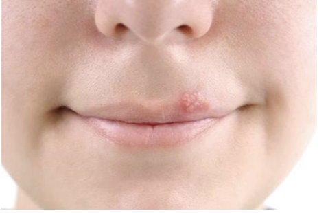 <p><span>How would you document this skin finding?</span></p>