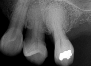 <p>What is the dental anomaly seen in this image?</p><p>&nbsp;</p><p>dilaceration</p><p>&nbsp;</p><p>pneumatization</p><p>&nbsp;</p><p>hypercementosis</p><p>&nbsp;</p><p>cancer</p>
