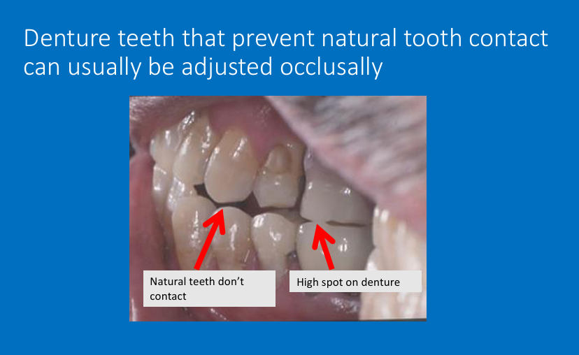 <p>metal framework and crowns - careful when recording jaw relationship as there is more room for adjustment in acrylic dentures</p>