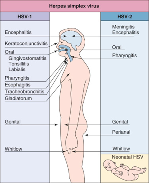 <p><strong>Herpes gladiatorum</strong> – occurs on the skin, often in athletes.</p>