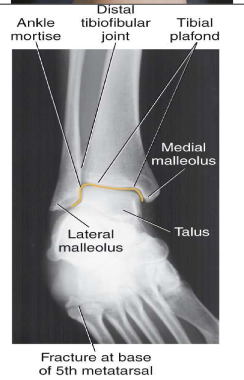 <p><span style="line-height: normal;"><span>• </span></span>Entire ankle mortise open</p><ul><li><p class="p1"><span style="line-height: normal;"><span> </span></span>Medial , lateral &amp; superior aspects</p></li></ul><p class="p1"><span style="line-height: normal;"><span>• </span></span>Distal ⅓ of tibia and fibula demonstrated</p><ul><li><p class="p1"><span style="line-height: normal;"><span> </span></span>Little, if any, overlap of distal tib/fib</p></li></ul><p class="p1"><span style="line-height: normal;"><span>• </span></span>Proximal ½ of metatarsals included</p><p class="p1"><span style="line-height: normal;"><span>• </span></span>Optimal exposure factors</p>