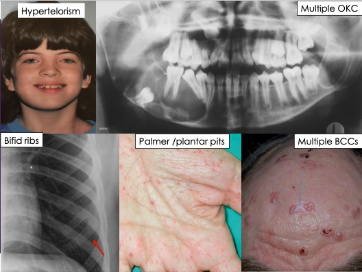 <p>What are the clinical features of odontogenic keratocyst?</p>