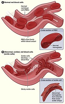 <ol><li><p>Теј-Саксова болест (Tay–Sachs disease)</p></li><li><p>Цистична фиброза </p></li><li><p>Српеста анемија (Sickle cell disease)</p></li><li><p>Албанизам </p></li><li><p>Фенилкетонурија (Phenylketonuria)</p><p></p></li></ol>