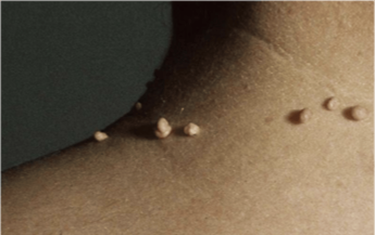 <p>name this skin pathology</p>