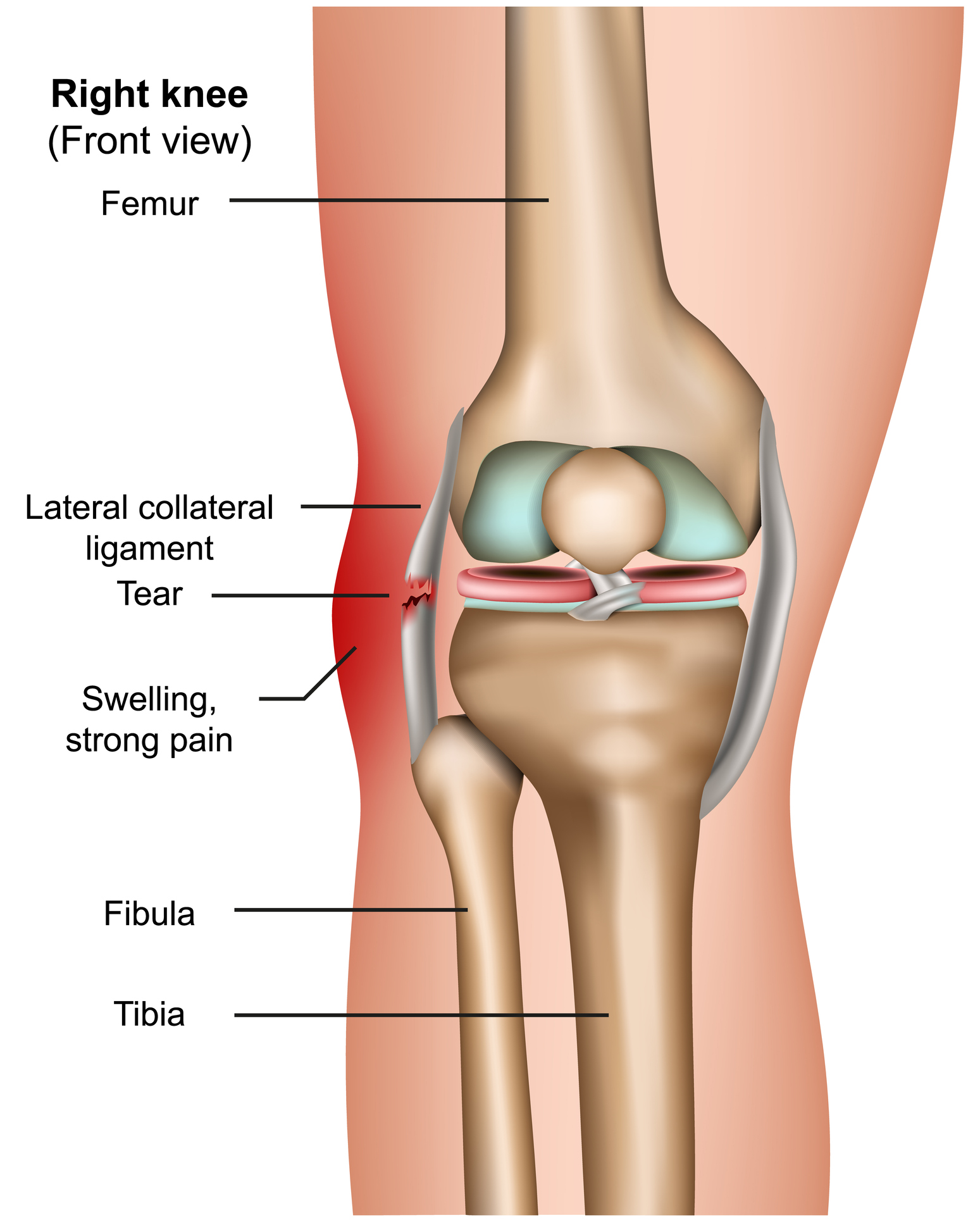 <p>outside of knee</p>