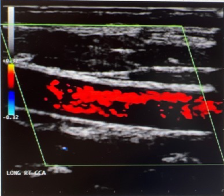 <p>What should be done to adjust and improve the color Doppler displayed on the image?</p><p>a. steer box <br>b. increase PRF <br>c. decrease sample volume<br>d. increase velocity scale</p>