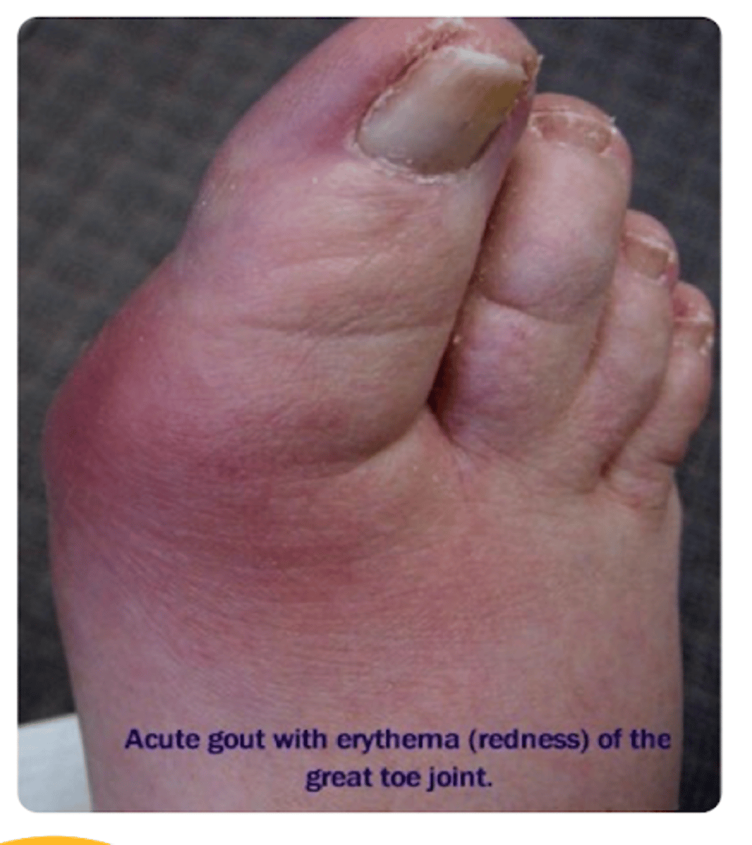 <p>Typically monoarticular --&gt; podagra (great toe affected)</p>