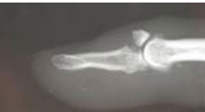 <p>What type of fracture is shown here?</p>