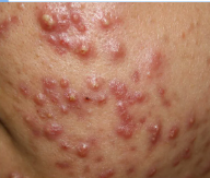 <p>develops from combinations of factors within the pilosebaceous unit (hair follicle and sebaceous gland) such as: </p><ol><li><p>excessive sebum production </p></li><li><p>follicular hyperkeratinization </p></li><li><p>cutibacterium acne colonization</p></li><li><p>inflammation </p></li></ol><p>(skin condition characterized by formation of inflammatory and non-inflammatory lesions on the face, chest, back) </p>