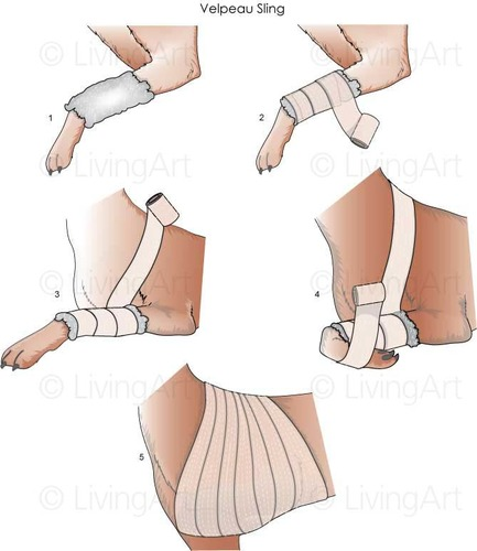 <ol><li><p>Conservative (Closed reduction &amp; stabilisation under sedation or anaesthesia using velpeau sling, in distracts humeral head laterally)</p></li><li><p>Surgical: Reconstruction of the glenohumeral ligaments and joint capsule. Transposition of either the biceps brachii tendon or supraspinatus tendon. Intraarticular pinning</p></li></ol><p></p>