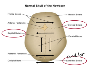 <p>premature fusion of teh coronal and saggital AND/OR lamdoid sutures </p><p></p>