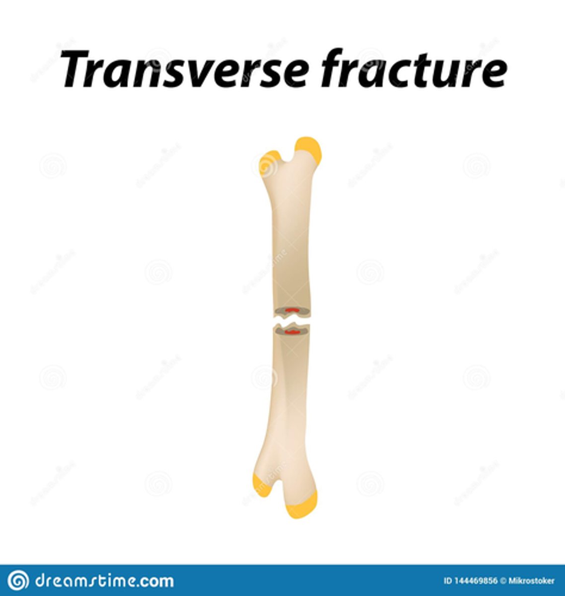 <p>Crosswise at right angles to the long axis of the bone.</p>