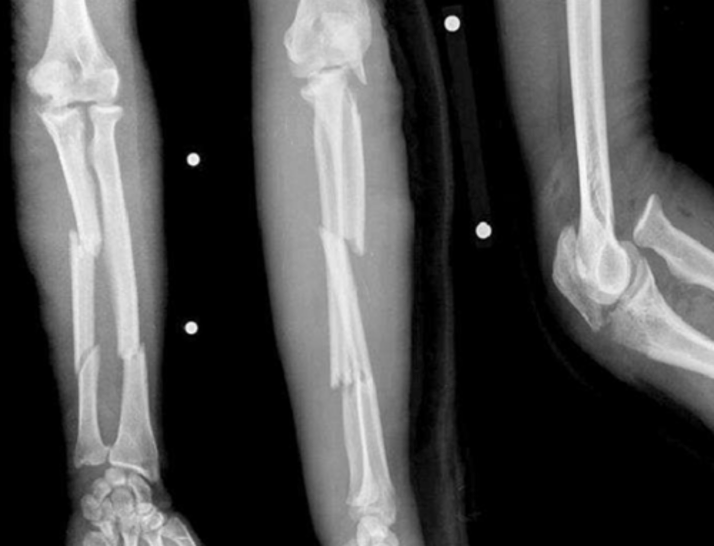 <p>What type of fracture is this?</p>