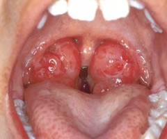 <p>abnormally enlarged tonsillar tissue</p>
