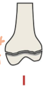 <p>Physeal fracture separating metaphysis and epiphysis</p>