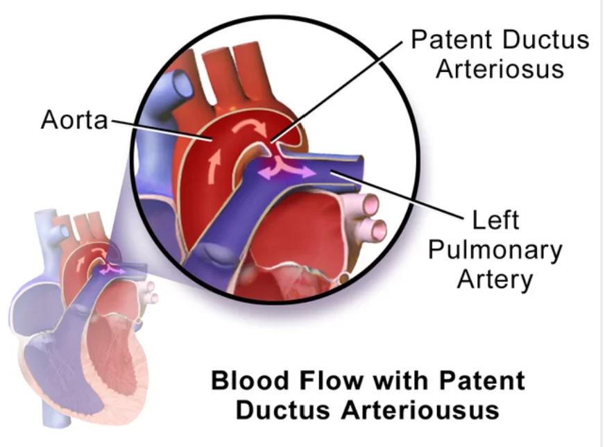 connection between aorta and left pulmonary artery in fetus --> ligamentum arteriosum 