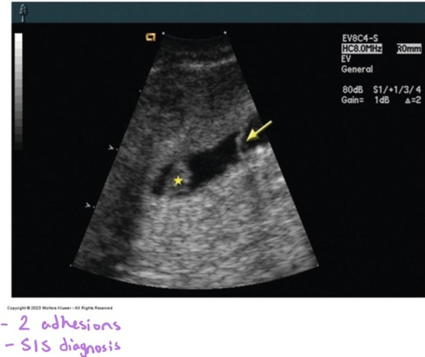 <p>Adhesions appear as echogenic bands</p>