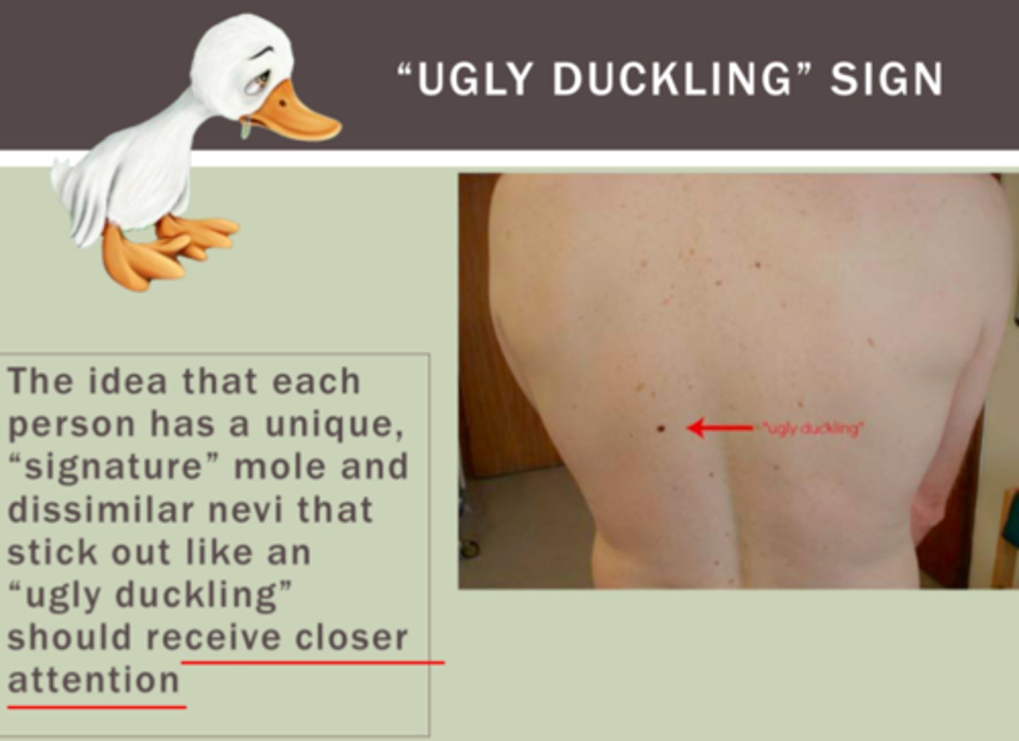 <p>The ugly duckling sign refers to a nevus that stands out and <strong>looks differen</strong>t from all the other nevi on the body of a person. It should be approached with a <strong>high index of suspicion</strong>. It is used as a clinical feature <strong>indicative of malignancy</strong> in a nevus.</p>