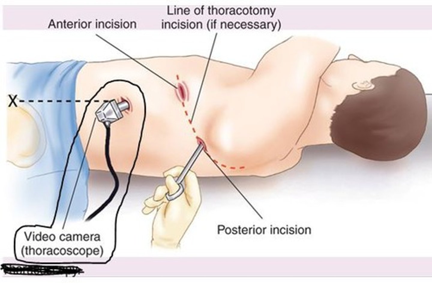 <p>instrument used for visual examination of the chest cavity (VAT)</p>