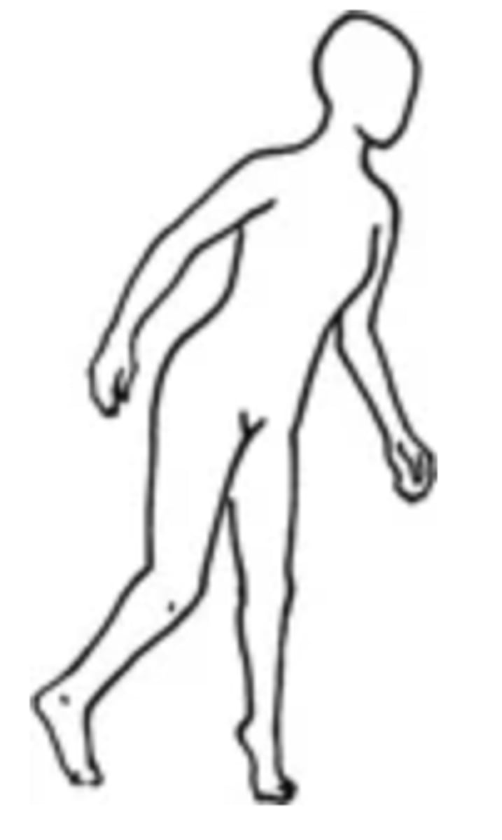 <p>- An abnormal gait in which a person has a leg length discrepancy &gt;2.5cm</p><p>- Can be caused by a congenital dislocated hip</p>