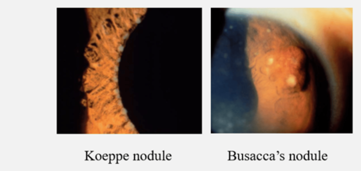 <p></p><p>- Koeppe nodule</p><p>- Busacca’s nodule</p><p>Granulomatous/nodules = granulomatous uveitis</p>
