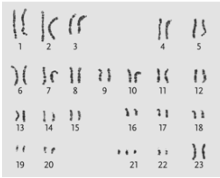 <p><span style="background-color: transparent; font-family: "Times New Roman", serif;"><span>57. Which genetic condition is revealed in the karyotype display shown in the accompanying figure?</span></span></p><table style="min-width: 75px;"><colgroup><col style="min-width: 25px;"><col style="min-width: 25px;"><col style="min-width: 25px;"></colgroup><tbody><tr><td colspan="1" rowspan="1" style="vertical-align: top; overflow: hidden; overflow-wrap: break-word;"><p><span style="background-color: transparent;"><span> </span></span></p></td><td colspan="1" rowspan="1" style="vertical-align: top; padding: 1.5pt 0pt; overflow: hidden; overflow-wrap: break-word;"><p><span style="background-color: transparent; font-family: "Times New Roman", serif;"><span>a. </span></span></p></td><td colspan="1" rowspan="1" style="vertical-align: top; padding: 1.5pt 20pt 1.5pt 0pt; overflow: hidden; overflow-wrap: break-word;"><p><span style="background-color: transparent; font-family: "Times New Roman", serif;"><span>Turner syndrome</span></span></p></td></tr><tr><td colspan="1" rowspan="1" style="vertical-align: top; overflow: hidden; overflow-wrap: break-word;"><p><span style="background-color: transparent;"><span> </span></span></p></td><td colspan="1" rowspan="1" style="vertical-align: top; padding: 1.5pt 0pt; overflow: hidden; overflow-wrap: break-word;"><p><span style="background-color: transparent; font-family: "Times New Roman", serif;"><span>b. </span></span></p></td><td colspan="1" rowspan="1" style="vertical-align: top; padding: 1.5pt 20pt 1.5pt 0pt; overflow: hidden; overflow-wrap: break-word;"><p><span style="background-color: transparent; font-family: "Times New Roman", serif;"><span>Down syndrome</span></span></p></td></tr><tr><td colspan="1" rowspan="1" style="vertical-align: top; overflow: hidden; overflow-wrap: break-word;"><p><span style="background-color: transparent;"><span> </span></span></p></td><td colspan="1" rowspan="1" style="vertical-align: top; padding: 1.5pt 0pt; overflow: hidden; overflow-wrap: break-word;"><p><span style="background-color: transparent; font-family: "Times New Roman", serif;"><span>c. </span></span></p></td><td colspan="1" rowspan="1" style="vertical-align: top; padding: 1.5pt 20pt 1.5pt 0pt; overflow: hidden; overflow-wrap: break-word;"><p><span style="background-color: transparent; font-family: "Times New Roman", serif;"><span></span><em><span>cri-du-chat</span></em></span></p></td></tr><tr><td colspan="1" rowspan="1" style="vertical-align: top; overflow: hidden; overflow-wrap: break-word;"><p><span style="background-color: transparent;"><span> </span></span></p></td><td colspan="1" rowspan="1" style="vertical-align: top; padding: 1.5pt 0pt; overflow: hidden; overflow-wrap: break-word;"><p><span style="background-color: transparent; font-family: "Times New Roman", serif;"><span>d. </span></span></p></td><td colspan="1" rowspan="1" style="vertical-align: top; padding: 1.5pt 20pt 1.5pt 0pt; overflow: hidden; overflow-wrap: break-word;"><p><span style="background-color: transparent; font-family: "Times New Roman", serif;"><span>Triple-X syndrome</span></span></p></td></tr><tr><td colspan="1" rowspan="1" style="vertical-align: top; overflow: hidden; overflow-wrap: break-word;"><p><span style="background-color: transparent;"><span> </span></span></p></td><td colspan="1" rowspan="1" style="vertical-align: top; padding: 1.5pt 0pt; overflow: hidden; overflow-wrap: break-word;"><p><span style="background-color: transparent; font-family: "Times New Roman", serif;"><span>e. </span></span></p></td><td colspan="1" rowspan="1" style="vertical-align: top; padding: 1.5pt 20pt 1.5pt 0pt; overflow: hidden; overflow-wrap: break-word;"><p><span style="background-color: transparent; font-family: "Times New Roman", serif;"><span>Klinefelter syndrome</span></span></p></td></tr></tbody></table><p></p>