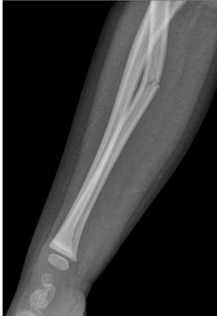 <p><span>This is an x-ray from a 10 year old child. Identify the type of fracture present in the x-ray below.&nbsp;</span></p>