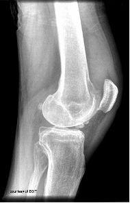 <p>Degenerative Joint Disease (Post-Traumatic Arthritis)</p>