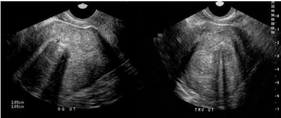 <p>what type of fibroid is this</p><p>a) submucosal</p><p>b) subserosal</p><p>c) pedunculated</p><p>d) intramural</p>