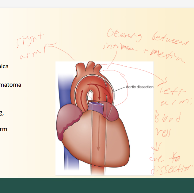 <ul><li><p>Tear in arterial lining between tunica intima and media</p></li><li><p>Forms HEMATOMA in blood wall</p></li><li><p>S/sx</p><ul><li><p>Pain in chest or back (sharp, ripping pain_</p></li><li><p>BP difference in arms</p><ul><li><p>Due to tear being in aorta, effects blood flow to body depending on where (LOOK AT PICTURE)</p></li></ul></li><li><p>WIDE pulse pressure</p></li></ul></li></ul><p></p>