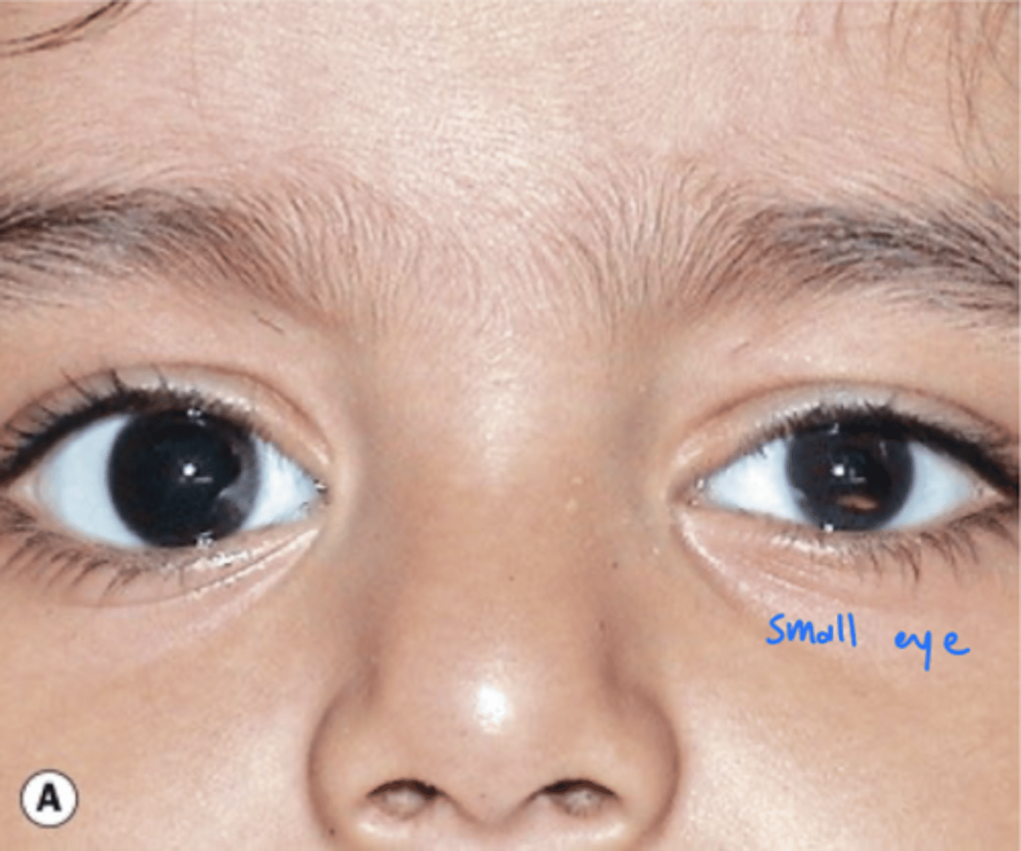 <p>those with:</p><p>1. CNS abnormalities</p><p>2. fetal alcohol syndrome</p><p>3. intrauterine infections</p>
