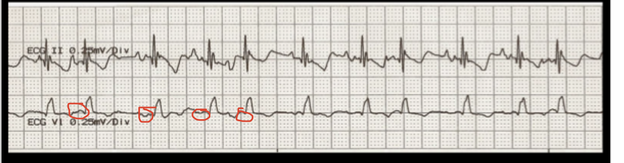 <p>How does one treat a wandering atrial pacemaker?</p>